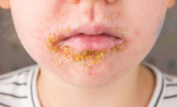 Child with impetigo around his mouth