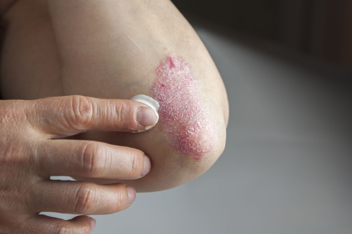 Close up of a person rubbing cream into psoriasis on their elbow