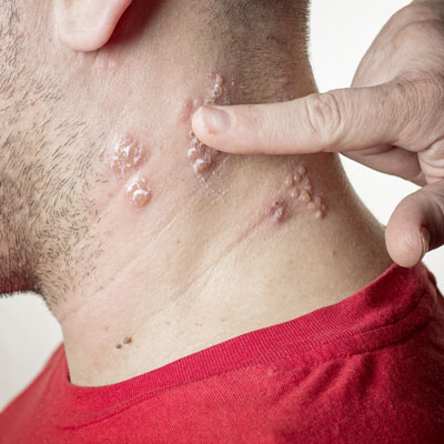 Close up of blisters on the side of a man's neck