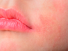 Close up of a woman's cheek with a red rash