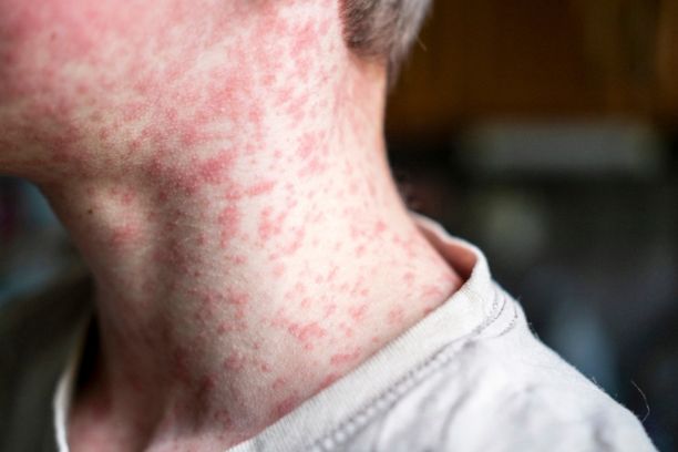 Measles