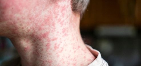 Measles outbreak: what you need to know about vaccines icon